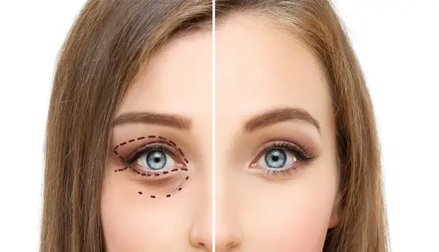 جراحی و زیبایی پلک