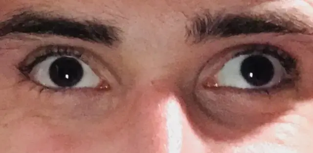 اصلاح انحراف چشم