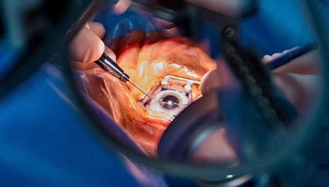 آب سیاه (گلوکوم)