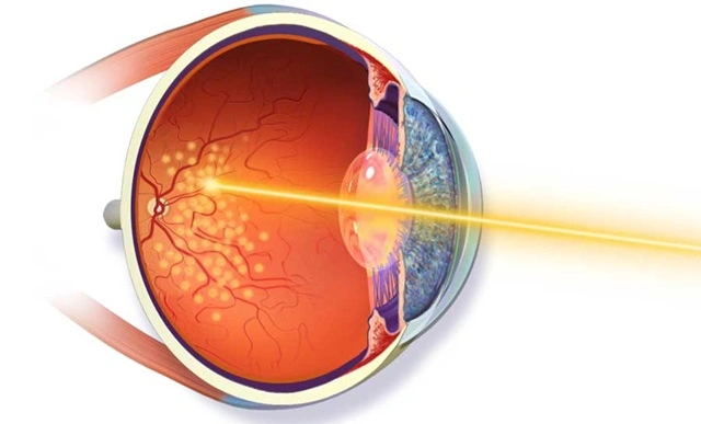 جراحی شبکیه و لیزر شبکیه